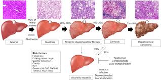 Alcoholic Liver Disease A Current Molecular And Clinical Perspective Sciencedirect