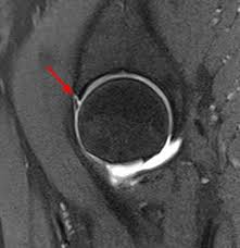 Image result for Hip Labral Tear
