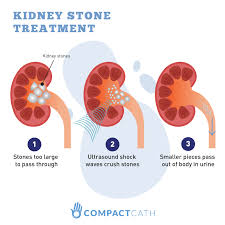 Can you have kidney stones that don't pass but cause no pain? Kidney Stones The Ultimate Beginner S Guide Compactcath