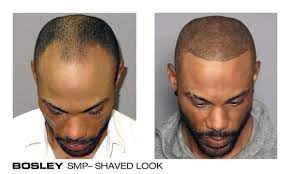 Hair transplantation has created a hope for the people who are suffering from baldness and hair fall. Bosley Hair Transplant Restoration 3379 Peachtree Rd Ne Atlanta Ga Hair Replacement Mapquest