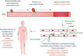 The transmission of pathogens carried by a tick bite (ixodes ricinus, ixodes vulgo). Progression Of Lyme Disease In Humans Following B Burgdorferi Infection