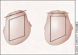 Image result for Positional Head Deformity