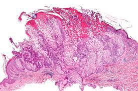 Muir Torre Syndrome Wikipedia