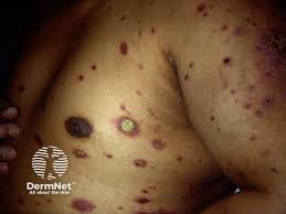 Image result for syphilis ulcer