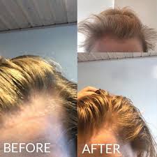 Blowout and bridal inspiration right this way! Receding Hairline 7 Effective Ways To Fight Back Against Hair Loss Hairlust Uk