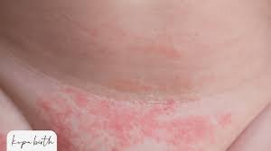 Image result for diaper dermatitis