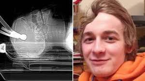 Dihajar dengan Palu, Tengkorak Pemuda Hilang Separuh