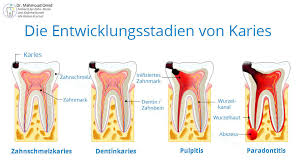 Solange die karies nur im zahnschmelz lokalisiert ist, kann sie noch ohne bohren therapiert werden. Karies Zahnfaule Med Kom