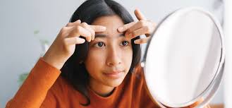Acne in Teenagers: Causes, Myths & Best Treatments in Bihar’s Climate