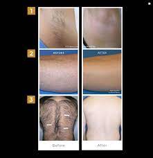 Unlike waxing and shaving, the treatments are quick and painless. Permanent Laser Hair Removal Treatment In Melbourne Kew