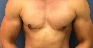 How to know if you re trans ftm. What Are The Positive Effects Of Ftm Top Surgery Ftm Top Surgery