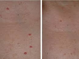 There is no known way to prevent angiomas. Cherry Angiomas Laser Treatment Lafayette La Renewed Med Spa