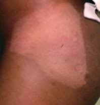 Image result for Postinflammatory Hypopigmentation