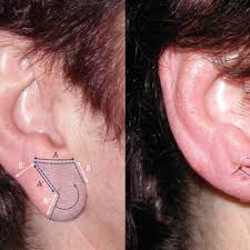 The sun reports that the modification is for her role in a new amazon series, carnival row, in which she plays vignette stonemoss, a faery fleeing persecution. props to the show for not falling. Earlobe Reduction With Minimally Visible Scars The Sub Antitragal Groove Technique Request Pdf