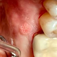 Image result for Centrostigma papillosum