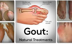 Image result for gout symptoms knee