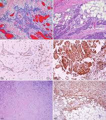 Mesothelioma tumors can consist of two different types of cells, including epithelioid and sarcomatoid. Https Patologi Com Guideline 20mesotheliom Pdf