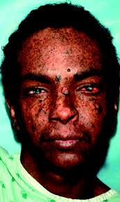 Oxidative DNA Damage and Nucleotide Excision Repair