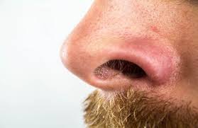 Pickel sind kein phänomen, das sich ausschließlich auf die pubertät beschränkt. Weisse Mitesser So Entstehen Sie Und So Wirst Du Sie Wieder Los