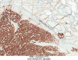 Pathology Outlines Hbme
