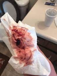 Bloody Show From Cervical Exam Warning Picture April 2018 Babies Forums What To Expect