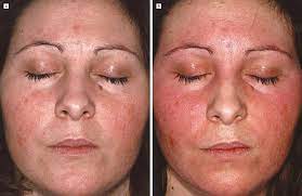 Apr 15, 2020 · signs and symptoms of alcohol intolerance — or of a reaction to ingredients in an alcoholic beverage — can include: Your Guide To Sudden Alcohol Intolerance Alcohol Allergies