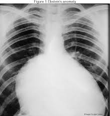 The Chest X Ray In Congenital Heart Disease 2 Semantic Scholar Huge collection, amazing choice, 100+ million high quality, affordable rf and rm images. chest x ray in congenital heart disease