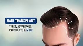 Image result for which hair transplant treatment is best for me