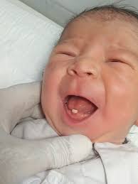 Image result for Neonatal Teeth