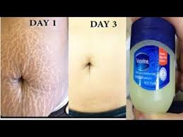 For best results, do this as often as you can for a month. 2 Remove Stretch Mark At Home In Few Days Using Vaseline Youtube Stretch Mark Removal Stretch Mark Remedies Stretch Mark Removal Cream