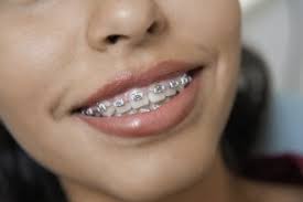 One thing you can be sure of though, is that it will be much quicker than when you. How Can I Get My Braces Off Faster Affinity Dental Affinity Dental
