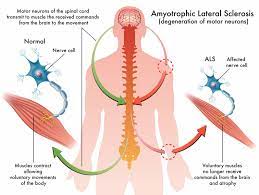La palabra amiotrófica significa sin nutrimento. Esclerosis Lateral Amiotrofica Ela