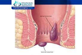 البواسير البواسير الداخلية البواسير الخارجية iranian surgery