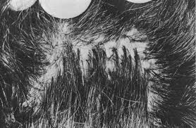 Super beard hairs pili multigemini cause amp treatment. Pili Multigemini Causes Symptoms Diagnosis Treatment