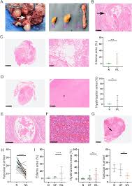 Pathological and molecular insights into intravenous leiomyomatosis: an  integrative multi-omics study