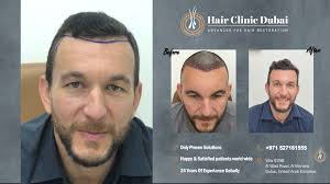 Hair Transplant Clinic Results