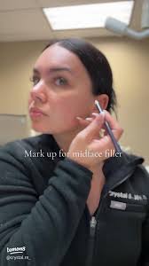 The Best Cheek Filler Technique with Tesoro Implant