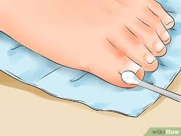 Maybe you would like to learn more about one of these? 3 Manieres De Se Debarrasser Des Ongles Incarnes