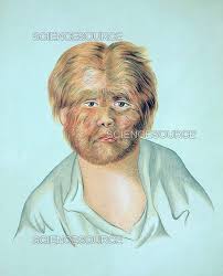 Image result for Hypertrichosis