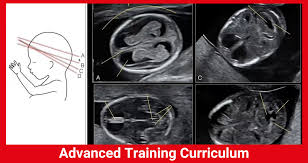 Image result for First Trimester Ultrasound