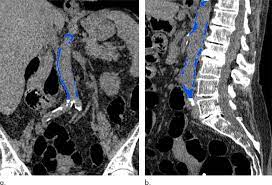 Abdominal Aortic Calcification May Signal Future Heart Attack