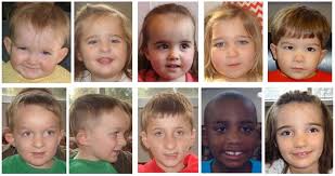 Figure 1 Children With Characteristic Facial Features Of 7q11 23 Duplication Syndrome Genereviews Ncbi Bookshelf