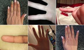 Radiating pain to pinky finger or the little finger occurs mainly due to the presence of cubital tunnel syndrome. Have You Got Smartphone Pinky Daily Mail Online