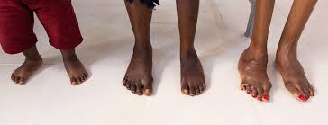 Image result for Clubfoot