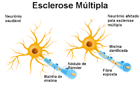 We did not find results for: Esclerose Multipla O Que E E Tratamento Mundo Educacao