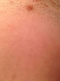 One of the common ways of getting an infected ingrown hair cyst is through touching, picking, pricking or tweezing using dirty sharp objects. Is This Brown Spot An Ingrown Hair Help Imgur