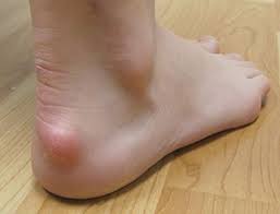 Tourette syndrome and comorbid pervasive developmental disorders. Trail Effect The Curse Of Pointy Heels Modifying Shoes For Haglund S Deformity