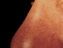 Maybe you would like to learn more about one of these? Lupus Pernio Dermnet Nz