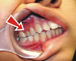 Is there a way to fix a slight overbite without having to wear something like retainers forever afterwards ? What Is A Crossbite Ask An Orthodontist Com