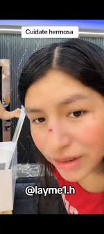 Caída inesperada y accidentes en mi día a día